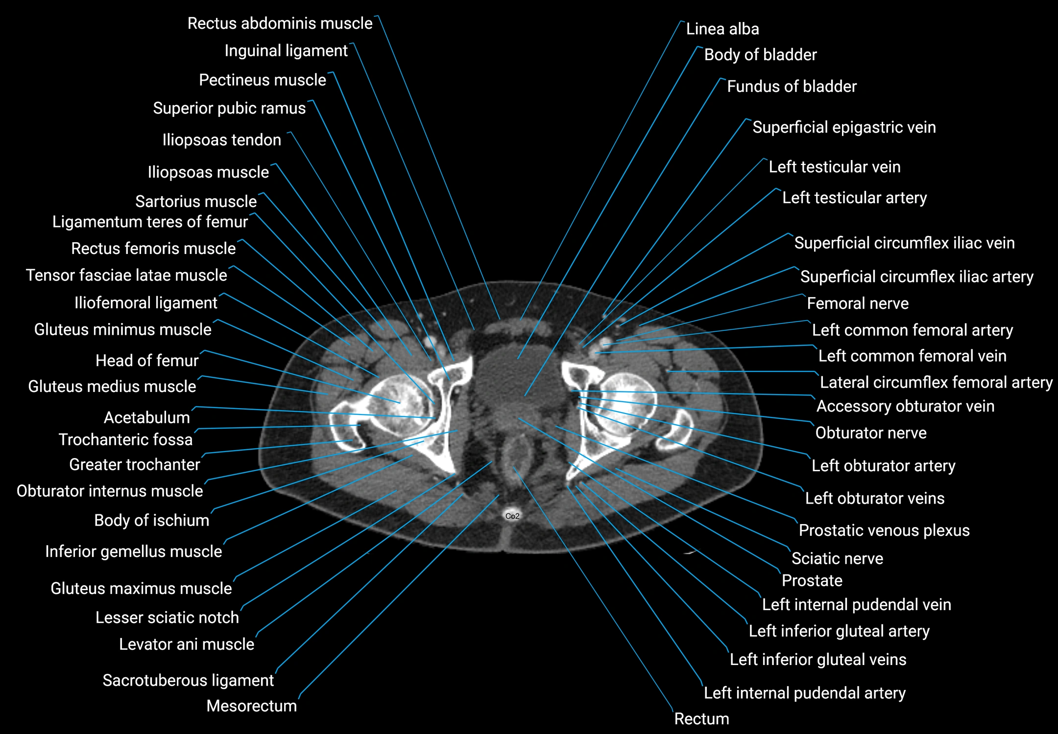 CT male pelvis axial cross sectional anatomy labelled radiology image -00190.webp